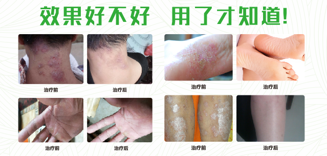 伊人婷婷视频真菌清噴劑